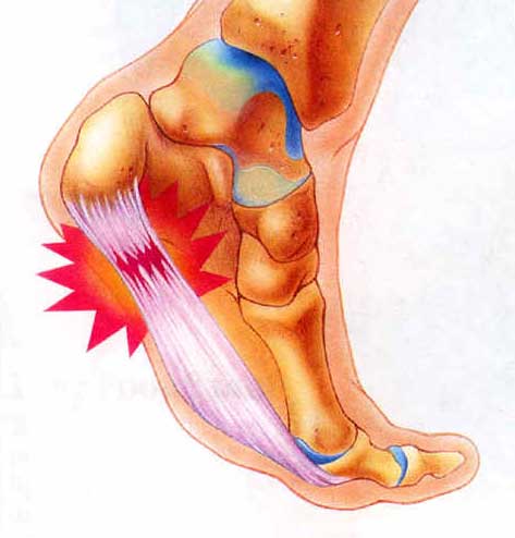 The Bones and Plantar Fascia of the Foot